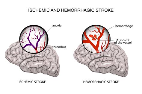 Deadly Stroke Triggers And How To Lower Your Stroke Risk Naturally