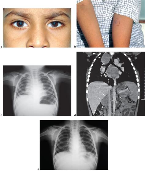 Pediatric Tuberculosis Anterior Uveitis American Academy Of Ophthalmology