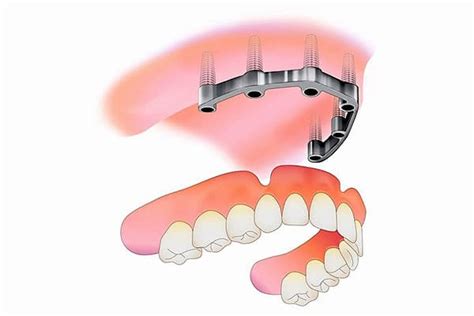 Implant Retained Dentures North Street Dental