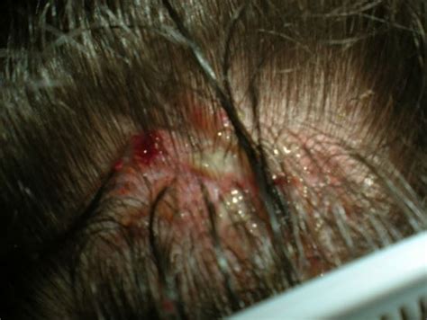 8 Best Sores On Scalp Images On Pinterest Sores On Scalp Hair