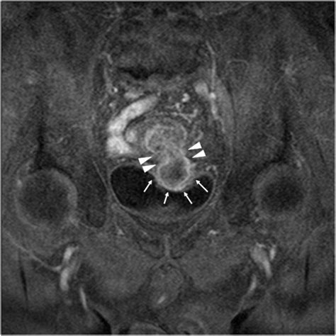 Enhanced Mri T1 Weighted Image Between The Sigmoid Colon And The