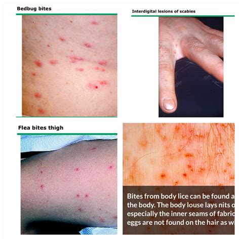 Bed Lice Bites Pictures
