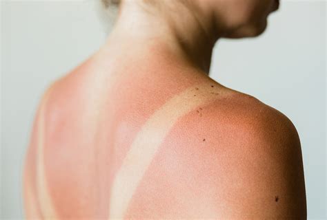 Sunburn Symptoms Risk Factors And Treatment Options