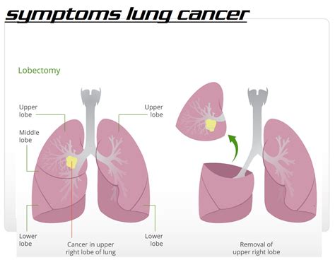 about lung cancer 3000 symptoms lung cancer