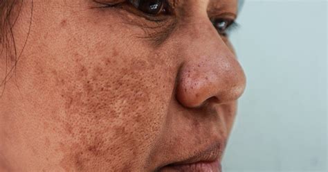The Best Melasma Treatments — How To Get Rid Of Melasma 2022 The