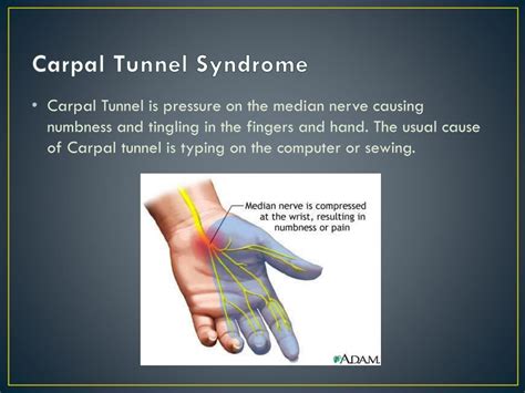 Ppt Carpal Tunnel Syndrome Powerpoint Presentation Free Download