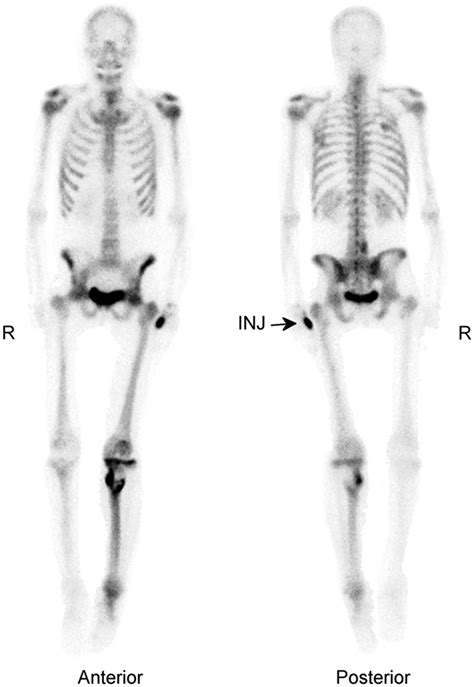 Dynamic Bone Imaging With 99mtc Labeled Diphosphonates And 18f Naf