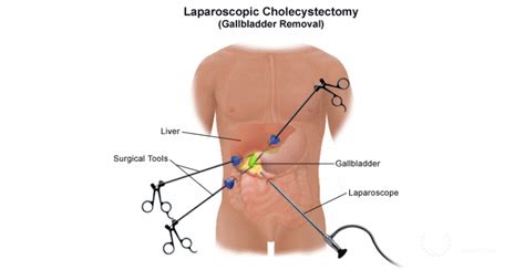 Laparoscopy Cholecystectomy Indications Diagnosis Benefits
