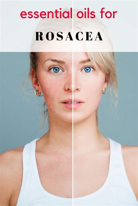 Essential Oils For Rosacea Essential Oils For Rosacea Rosacea Skin