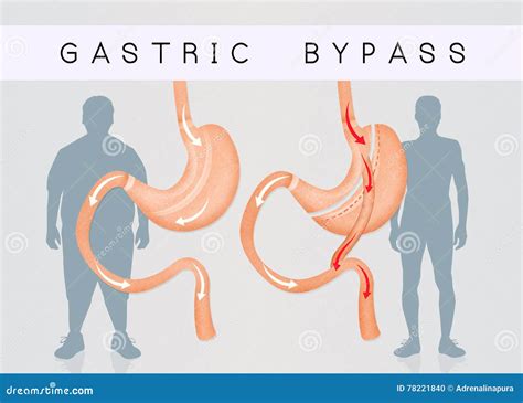 Before And After Gastric Bypass Surgery Stock Illustration Illustration Of Care Diet 78221840