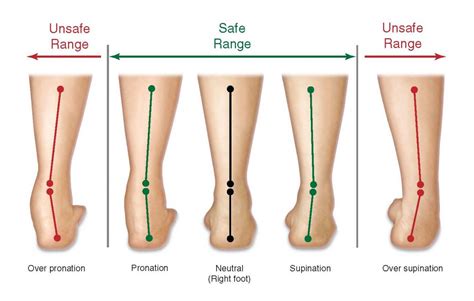 What Is Overpronation Of The Foot