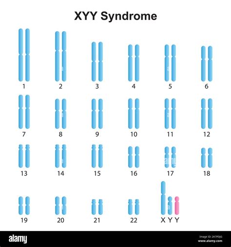Scientific Designing Of Jacobs Syndrome Xyy Karyotype Colorful Symbols Vector Illustration