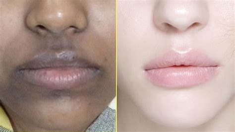 How To Remove Dark Black Spots On Lips