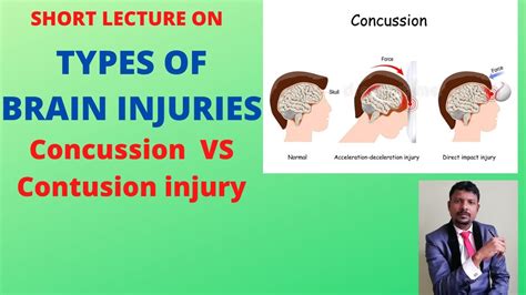 Types Of Brain Injury Concussion Vs Contusion Youtube
