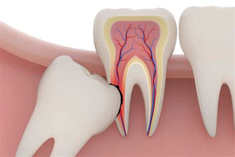 Wisdom Tooth Extraction Miami Fl Dentist Brickell Dental General