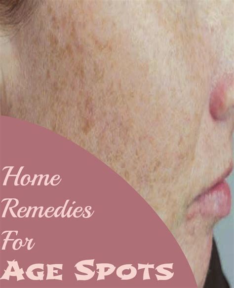 Home Remedies For Age Spots Tips Park