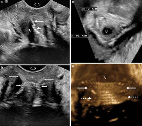Sagittal 2 D Grayscale Ultrasound Image Demonstrating Two Linear