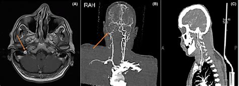 Right Carotid Artery Dissection On Contrastenhanced MR Angiography