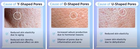 Different Types Of Pores Insert Image 2