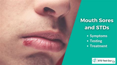 Mouth Sores Causing Stds Symptoms Treatment And Testing In The Us