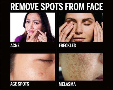 How To Remove Spots From Face