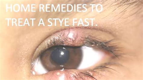 How To Get Rid Of A Stye Remedies And Treatment Want To Get Rid Of