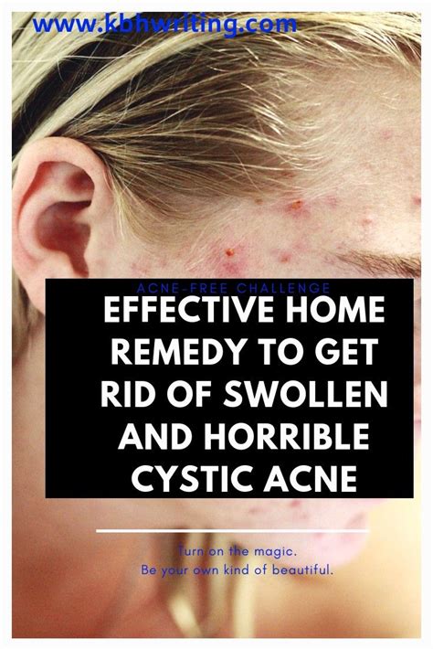 Effective Home Remedies To Get Rid Of Swollen Painful Cystic Acne