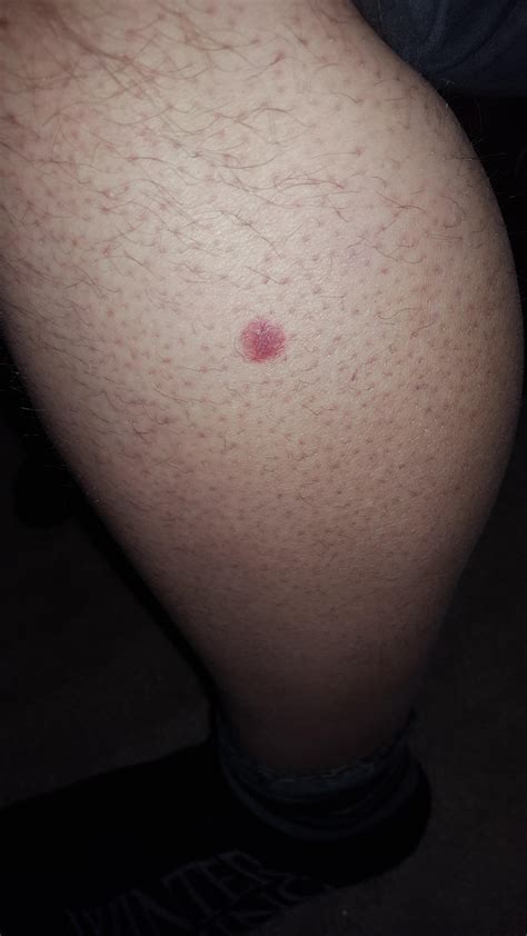 Red Spot On Leg Not Painful Or Itchy Been There A Week And Is Slightly