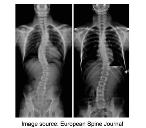 How X Rays Are Used To Diagnose Scoliosis Physioelements Physical Therapy
