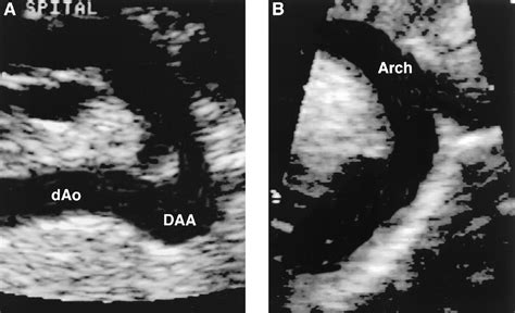 Isolated Ductus Arteriosus Aneurysm In The Fetus And Infant A Multi