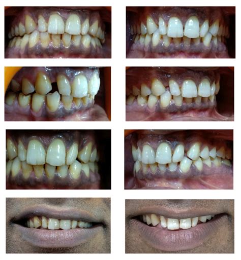 I told her how much suboxone you had taken over the past 2 1/2 days, so i believe she is accurate. How Much Is It For Your Teeth Whitening - TeethWalls