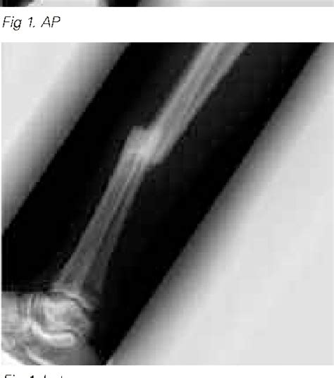 Figure 1 From Fixation And Deformity Correction By Plate Osteosynthesis