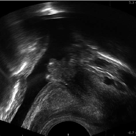 Transrectal Ultrasonography Shows A 14 Cm Echogenic Mass That