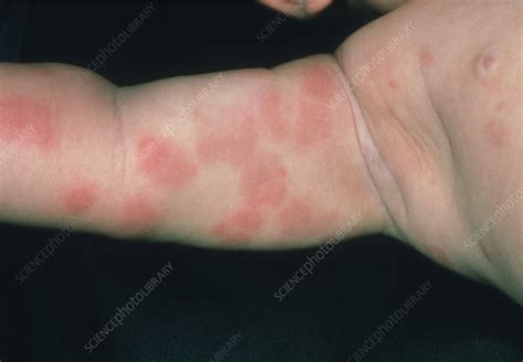 Rash On Babys Arm Due To Food Allergy Stock Image M3200213