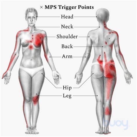 Myofascial Pain Syndrome Reasons For Your Muscle Pain Buoy Leg Pain Back Pain Knee