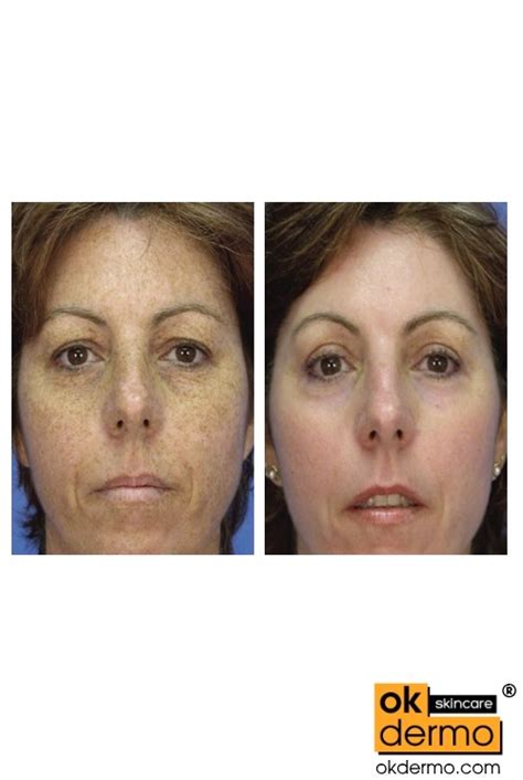 Tretinoin And Hydroquinone Before And After