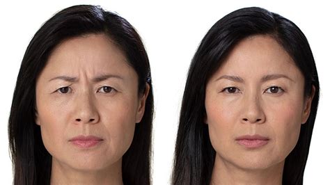 5 Top Ways To Erase Forehead Lines Laser Skin Resurfacing Botox