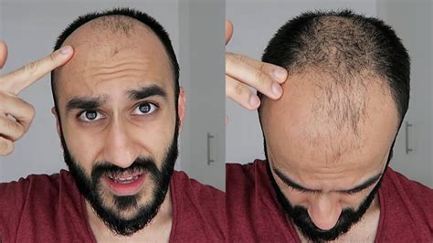 Growing Out My Balding Hair Hair Loss And Why Bald Will Always Be