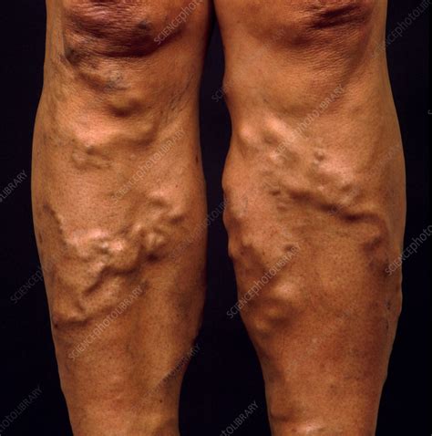 Varicose Veins On A Womans Legs Below The Knee Stock Image M290