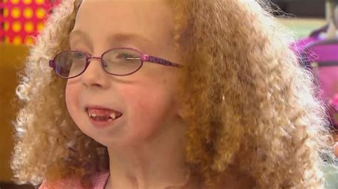 Girl With Rare Condition Born Without Jaw Wsyx