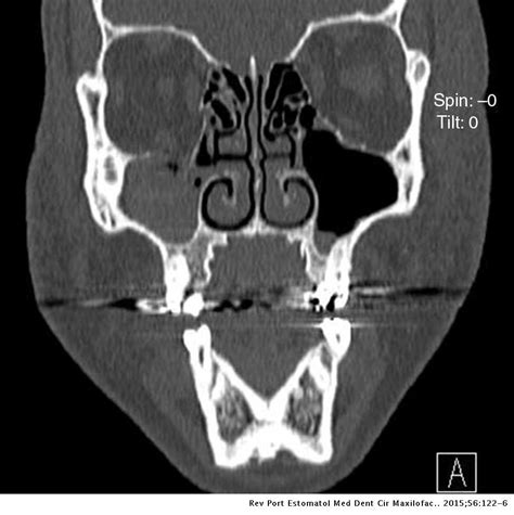 Reconstruction Of Orbital Floor For Treatment Of A Pure Blowout