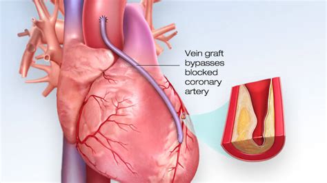 Coronary Artery Bypass Surgery Procedure Recovery Meril Life