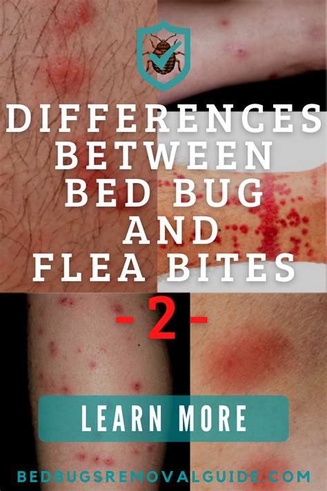 Bed Bug Bites Are Bigger Than Flea Bites And Flea Bites Tend To Be