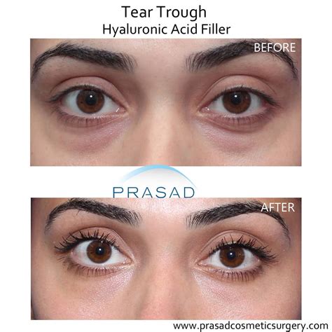 Under Eye Filler Before And After Photos Prasad Cosmetic Surgery Ny