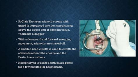 Adenoidectomy And Tonsillectomy Ppt
