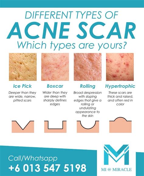 Acne Scar Removal Miracle Skin Laser And Aesthetic Centre