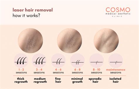Laser Hair Removal Price Benefits Cosmo Aesthetic