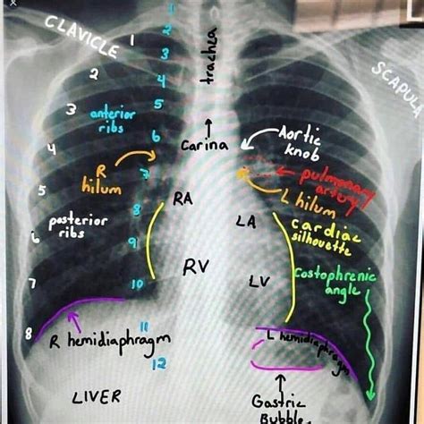 Medical Case Presentation On Instagram Normal Chest X Ray Labeled