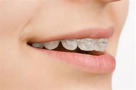 Reasons To Consider Clear Braces Henry Orthodontics Pinehurst