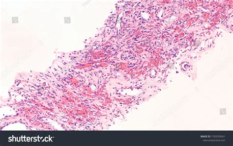 Kaposis Sarcoma Type Cancer Blood Vessels Stock Photo 1765559561